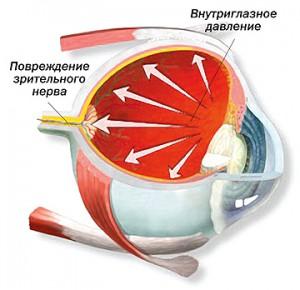 Глаукома у взрослых